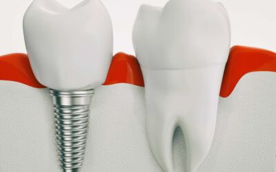 How to Maintain Your Dental Implants for a Lifetime