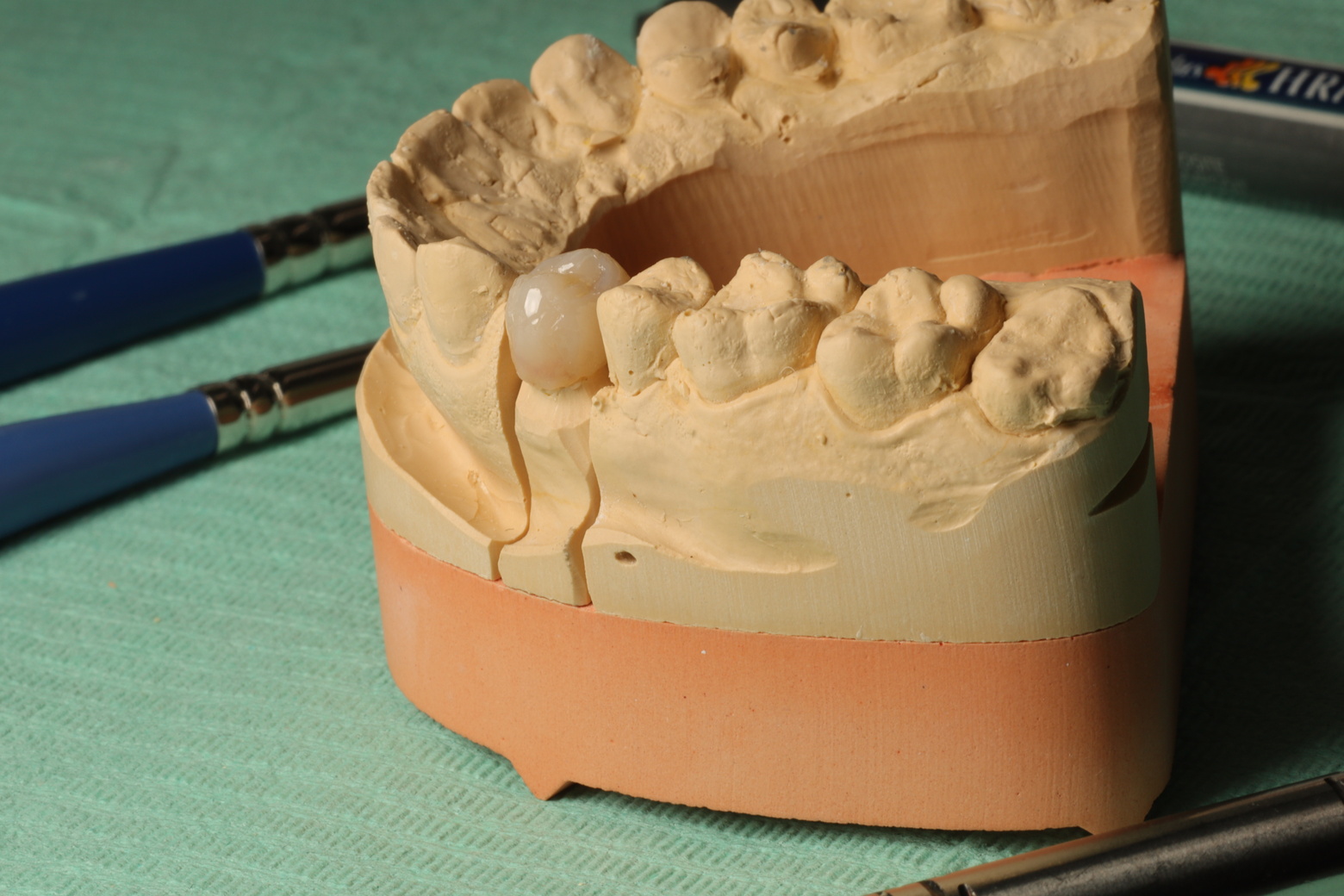 Quick Facts Regarding Dental Crowns & Restorative Dentistry