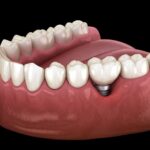 Dental Implants in Tavistock