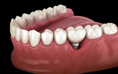 The Benefits of Dental Implants in Tavistock: A Complete Guide