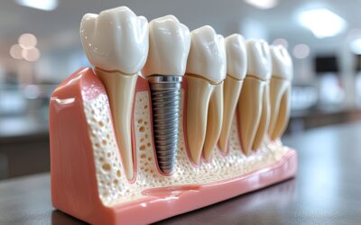 What to Expect During a Dental Implant Procedure