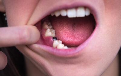 What is the Downside to Dental Implants?