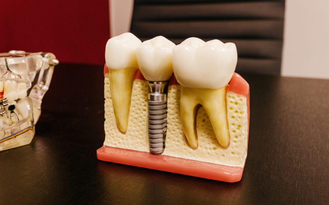 Dental Implants Tavistock