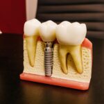 Dental Implants Tavistock