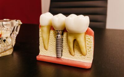 Missing a Full Arch? The Benefits of All-on-6 Dental Implants in Tavistock