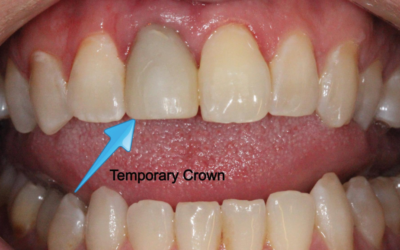 Top Tips to Keep Temporary Crowns From Falling Off